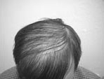 Before Hair Transplantation