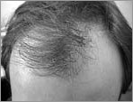 Before Hair Transplantation