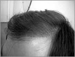 After Hair Transplantation